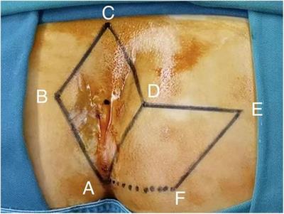 The application of ERAS in pilonidal sinus: comparison of postoperative recovery between primary suture and Limberg flap procedure in a multicenter prospective randomized trial